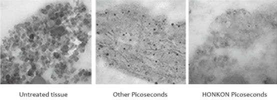 Picosecond διακοπτών αφαίρεση δερματοστιξιών λέιζερ διάμετρος σημείων 2 - 10mm για Beauty SPA 6