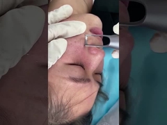 Picosecond σαλονιών 1064nm 532nm μηχανή λέιζερ για την επεξεργασία προβλήματος τραυμάτων χρώσης δερμάτων