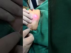 Επαγγελματική μηχανή μείωσης λίπους 1470nm Διοδίου Laser ορατά αποτελέσματα σε 2-3 συνεδρίες