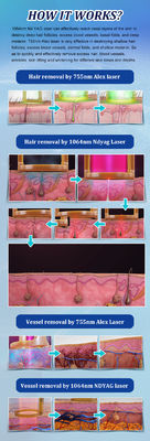 Pigment Lesions Removal Lasering 755 1064nm Alex Long Pulse Shorter Pulse Alexandrite Yag Lasering Hair Removal Machine