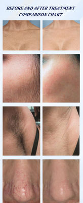 Pigment Lesions Removal Lasering 755 1064nm Alex Long Pulse Shorter Pulse Alexandrite Yag Lasering Hair Removal Machine
